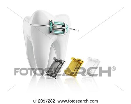 Tooth with bracket, illustration. View Large Photo Image Stock Image - Tooth with bracket, illustration.. Fotosearch