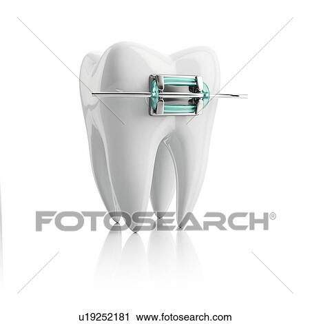 Tooth with bracket, illustration. View Large Photo Image Stock Image - Tooth with bracket, illustration.. Fotosearch
