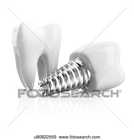 Tooth with implant, illustration. View Large Photo Image Stock Photo - Tooth with implant, illustration.. Fotosearch