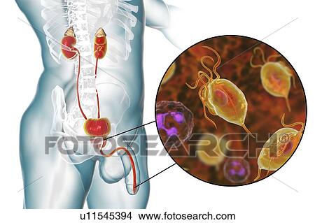 Picture - Trichomoniasis. Computer illustration of the male urinary system and the parasitic microorganism Trichomonas vaginalis, which is the causative agent of trichomoniasis. Trichomoniasis is a common cause of urethritis and prostatitis in men and is a.... Fotosearch