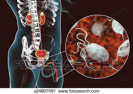 Stock Image - Trichomoniasis. Computer illustration of the male urinary system and the parasitic microorganism Trichomonas vaginalis, which is the causative agent of trichomoniasis. Trichomoniasis is a common cause of urethritis and prostatitis in men and is a.... Fotosearch