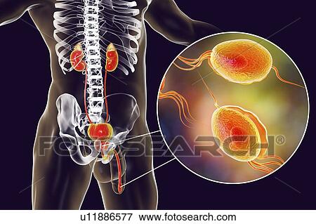 Trichomoniasis. Computer illustration of the male urinary system and the parasitic microorganism Trichomonas vaginalis, which is the causative agent of trichomoniasis. Trichomoniasis is a common cause of urethritis and prostatitis in men and is a... View Large Photo Image Stock Photo - Trichomoniasis. Computer illustration of the male urinary system and the parasitic microorganism Trichomonas vaginalis, which is the causative agent of trichomoniasis. Trichomoniasis is a common cause of urethritis and prostatitis in men and is a.... Fotosearch