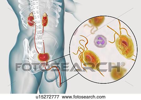 Stock Photo - Trichomoniasis. Computer illustration of the male urinary system and the parasitic microorganism Trichomonas vaginalis, which is the causative agent of trichomoniasis. Trichomoniasis is a common cause of urethritis and prostatitis in men and is a.... Fotosearch