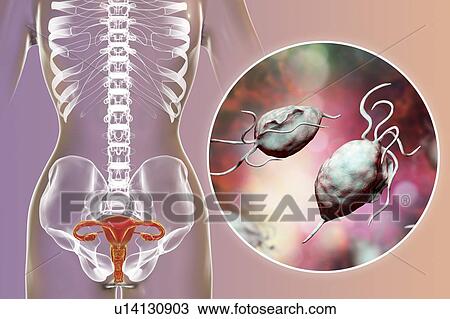 Trichomoniasis, illustration. Computer illustration of the female reproductive system and the parasitic microorganism Trichomonas vaginalis, which is the causative agent of trichomoniasis. Trichomoniasis is a common cause of vaginitis and is a... View Large Photo Image Stock Image - Trichomoniasis, illustration. Computer illustration of the female reproductive system and the parasitic microorganism Trichomonas vaginalis, which is the causative agent of trichomoniasis. Trichomoniasis is a common cause of vaginitis and is a.... Fotosearch