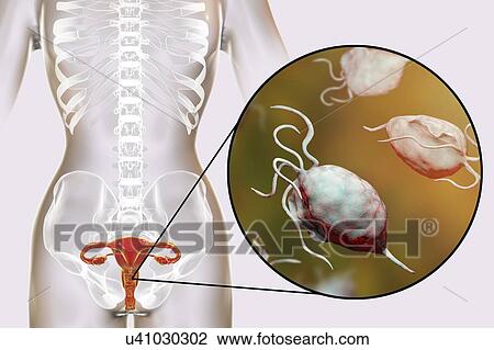 Stock Image - Trichomoniasis, illustration. Computer illustration of the female reproductive system and the parasitic microorganism Trichomonas vaginalis, which is the causative agent of trichomoniasis. Trichomoniasis is a common cause of vaginitis and is a.... Fotosearch
