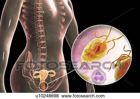 Trichomoniasis, illustration. Computer illustration of the female reproductive system and the parasitic microorganism Trichomonas vaginalis, which is the causative agent of trichomoniasis. Trichomoniasis is a common cause of vaginitis and is a... View Large Photo Image Stock Photo - Trichomoniasis, illustration. Computer illustration of the female reproductive system and the parasitic microorganism Trichomonas vaginalis, which is the causative agent of trichomoniasis. Trichomoniasis is a common cause of vaginitis and is a.... Fotosearch