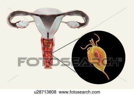 Stock Photo - Trichomoniasis, illustration. Computer illustration of the female reproductive system and the parasitic microorganism Trichomonas vaginalis, which is the causative agent of trichomoniasis. Trichomoniasis is a common cause of vaginitis and is a.... Fotosearch