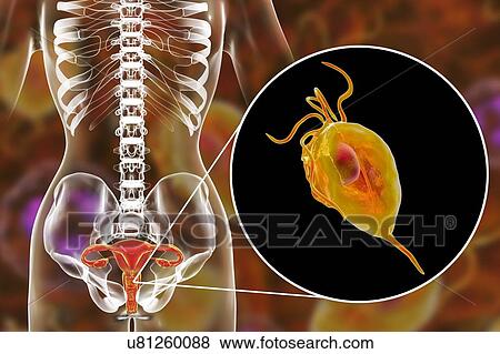 Trichomoniasis, illustration. Computer illustration of the female reproductive system and the parasitic microorganism Trichomonas vaginalis, which is the causative agent of trichomoniasis. Trichomoniasis is a common cause of vaginitis and is a... View Large Photo Image Stock Photo - Trichomoniasis, illustration. Computer illustration of the female reproductive system and the parasitic microorganism Trichomonas vaginalis, which is the causative agent of trichomoniasis. Trichomoniasis is a common cause of vaginitis and is a.... Fotosearch