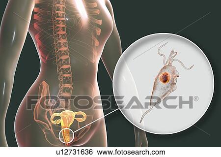 Trichomoniasis, illustration. Computer illustration of the female reproductive system and the parasitic microorganism Trichomonas vaginalis, which is the causative agent of trichomoniasis. Trichomoniasis is a common cause of vaginitis and is a... View Large Photo Image Stock Photograph - Trichomoniasis, illustration. Computer illustration of the female reproductive system and the parasitic microorganism Trichomonas vaginalis, which is the causative agent of trichomoniasis. Trichomoniasis is a common cause of vaginitis and is a.... Fotosearch