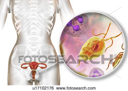 Stock Photograph - Trichomoniasis, illustration. Computer illustration of the female reproductive system and the parasitic microorganism Trichomonas vaginalis, which is the causative agent of trichomoniasis. Trichomoniasis is a common cause of vaginitis and is a.... Fotosearch