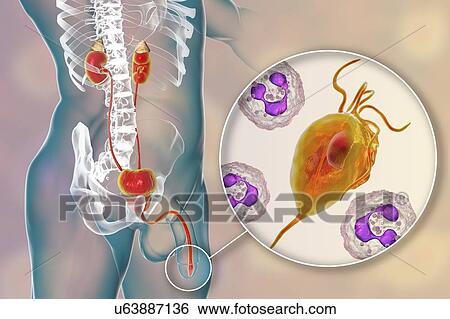 Stock Photograph - Trichomoniasis, illustration. Computer illustration of the male reproductive system and the parasitic microorganism Trichomonas vaginalis, which is the causative agent of trichomoniasis. Trichomoniasis is a common cause of urethritis and prostatitis.... Fotosearch