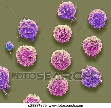 Stock Photo - White blood cells and a platelet. Coloured scanning electron micrograph (SEM) of white blood cells and a single platelet (blue). Platelets are fragments of white blood cells that under normal circumstances are small and biconcave in form. However, if.... Fotosearch