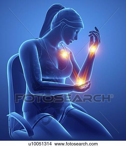Picture - Woman with arm pain, computer illustration.. Fotosearch