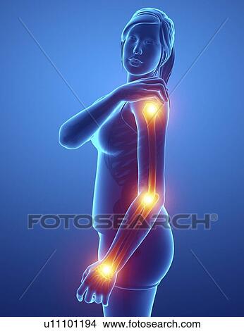 Woman with arm pain, computer illustration. View Large Photo Image Picture - Woman with arm pain, computer illustration.. Fotosearch