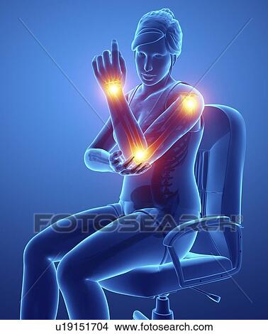 Woman with arm pain, computer illustration. View Large Photo Image Picture - Woman with arm pain, computer illustration.. Fotosearch