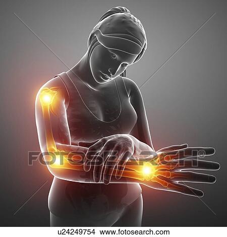 Picture - Woman with arm pain, computer illustration.. Fotosearch