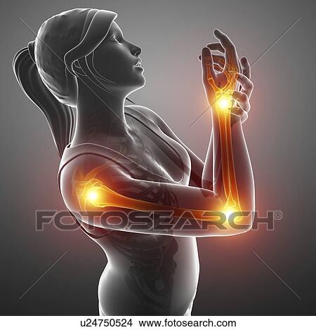 Picture - Woman with arm pain, computer illustration.. Fotosearch