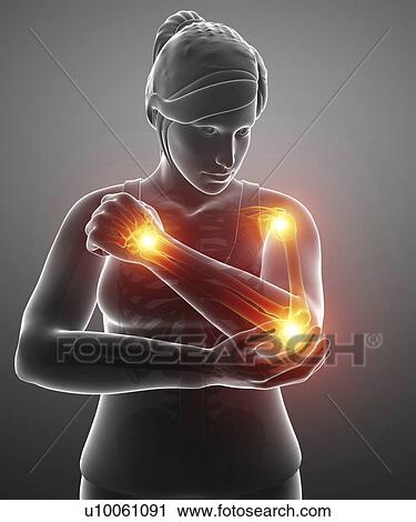 Stock Image - Woman with arm pain, computer illustration.. Fotosearch