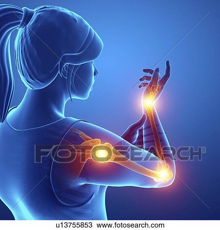 Stock Image - Woman with arm pain, computer illustration.. Fotosearch