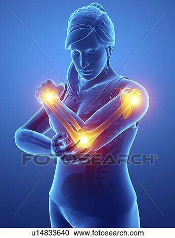 Stock Image - Woman with arm pain, computer illustration.. Fotosearch