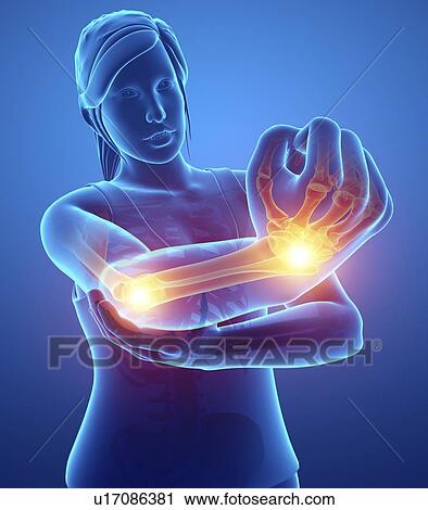 Woman with arm pain, computer illustration. View Large Photo Image Stock Image - Woman with arm pain, computer illustration.. Fotosearch