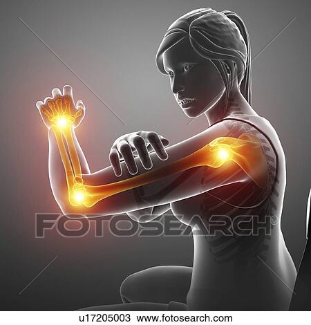 Woman with arm pain, computer illustration. View Large Photo Image Stock Image - Woman with arm pain, computer illustration.. Fotosearch