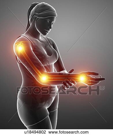 Woman with arm pain, computer illustration. View Large Photo Image Stock Image - Woman with arm pain, computer illustration.. Fotosearch