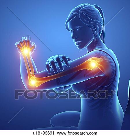 Stock Image - Woman with arm pain, computer illustration.. Fotosearch
