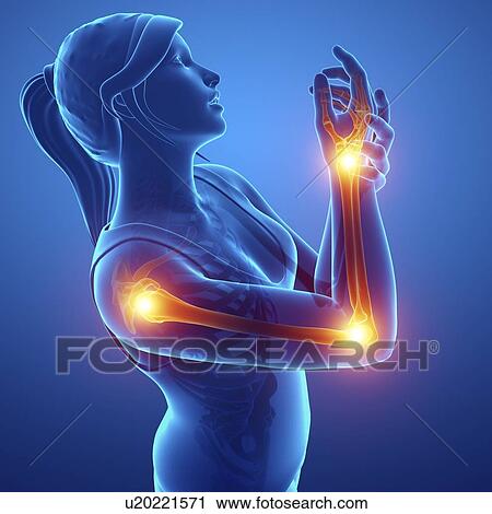 Stock Image - Woman with arm pain, computer illustration.. Fotosearch