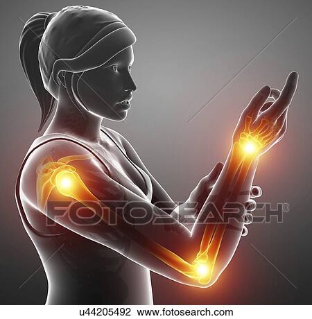 Stock Image - Woman with arm pain, computer illustration.. Fotosearch
