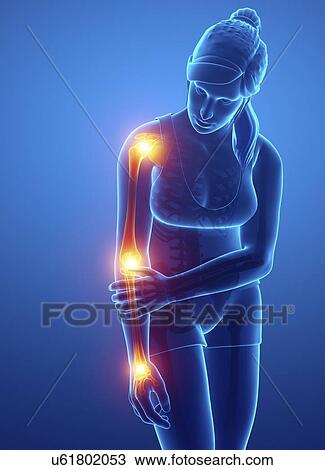 Stock Image - Woman with arm pain, computer illustration.. Fotosearch
