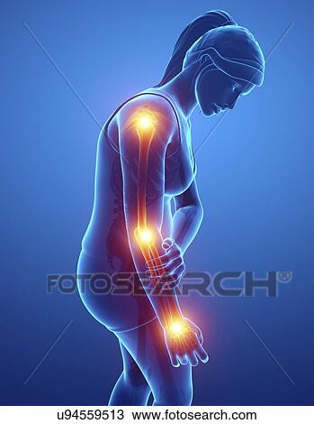 Woman with arm pain, computer illustration. View Large Photo Image Stock Image - Woman with arm pain, computer illustration.. Fotosearch