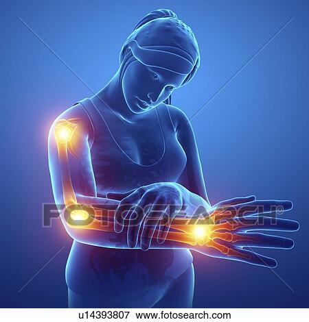 Woman with arm pain, computer illustration. View Large Photo Image Stock Photo - Woman with arm pain, computer illustration.. Fotosearch