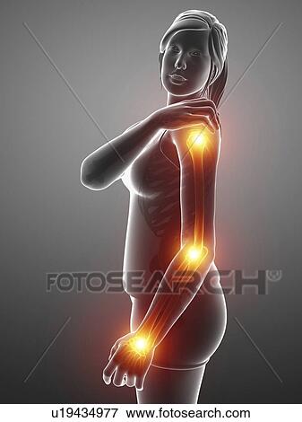 Woman with arm pain, computer illustration. View Large Photo Image Stock Photo - Woman with arm pain, computer illustration.. Fotosearch