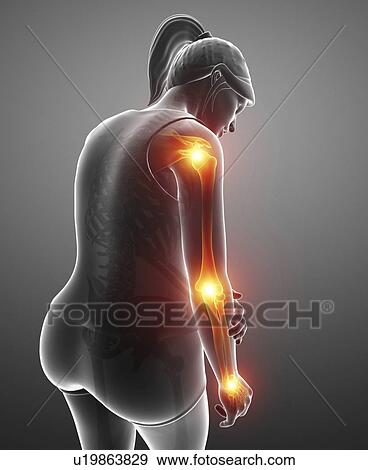 Stock Photo - Woman with arm pain, computer illustration.. Fotosearch