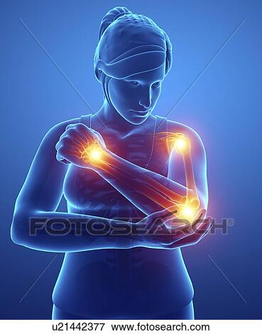 Woman with arm pain, computer illustration. View Large Photo Image Stock Photo - Woman with arm pain, computer illustration.. Fotosearch