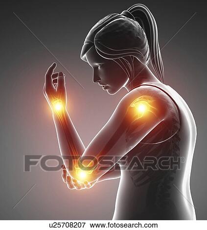 Stock Photo - Woman with arm pain, computer illustration.. Fotosearch