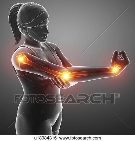 Woman with arm pain, computer illustration. View Large Photo Image Stock Photograph - Woman with arm pain, computer illustration.. Fotosearch