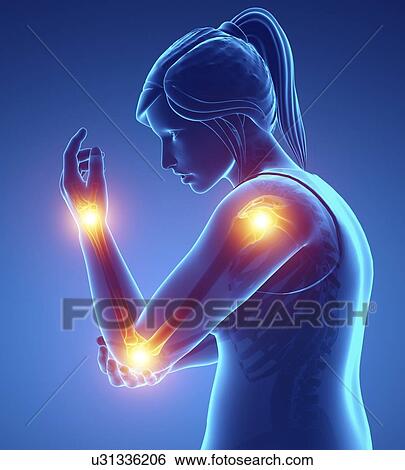 Woman with arm pain, computer illustration. View Large Photo Image Stock Photograph - Woman with arm pain, computer illustration.. Fotosearch