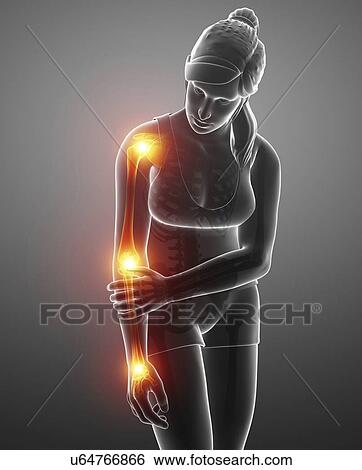Stock Photograph - Woman with arm pain, computer illustration.. Fotosearch