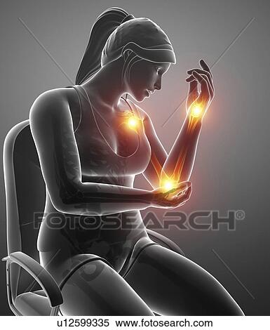 Woman with arm pain, computer illustration. View Large Photo Image Stock Photography - Woman with arm pain, computer illustration.. Fotosearch