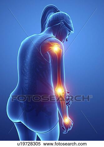 Stock Photography - Woman with arm pain, computer illustration.. Fotosearch