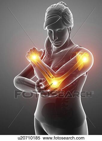 Stock Photography - Woman with arm pain, computer illustration.. Fotosearch
