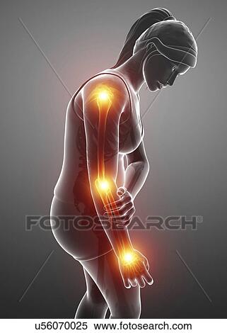 Woman with arm pain, computer illustration. View Large Photo Image Stock Photography - Woman with arm pain, computer illustration.. Fotosearch