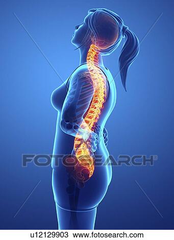 Stock Image - Woman with back pain, computer illustration.. Fotosearch