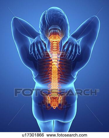 Stock Photograph - Woman with back pain, computer illustration.. Fotosearch
