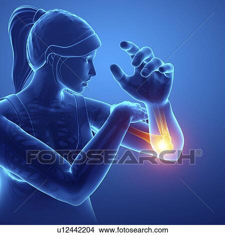 Picture - Woman with elbow pain, computer illustration.. Fotosearch