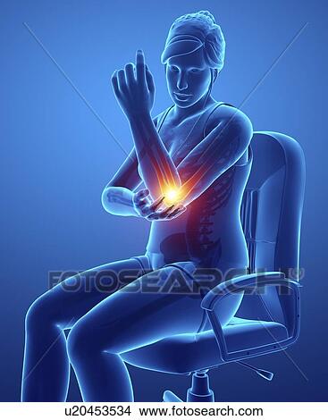 Picture - Woman with elbow pain, computer illustration.. Fotosearch