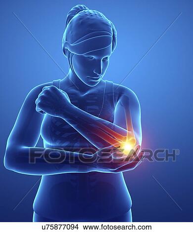 Picture - Woman with elbow pain, computer illustration.. Fotosearch