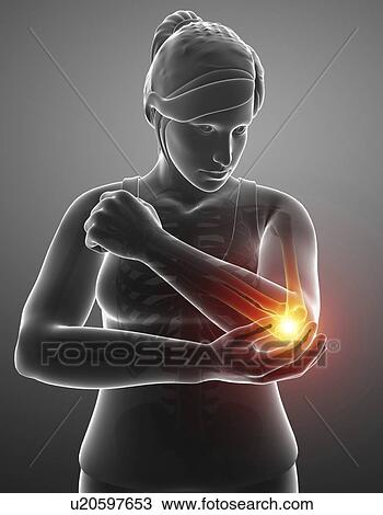 Woman with elbow pain, computer illustration. View Large Photo Image Stock Image - Woman with elbow pain, computer illustration.. Fotosearch